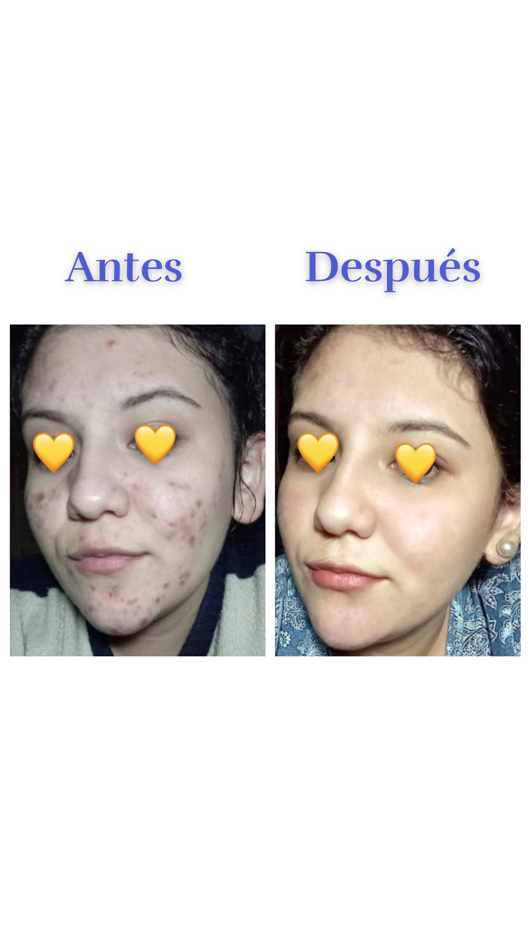 Elimina acné y manchas para siempre - Kit Skin Beauty Care